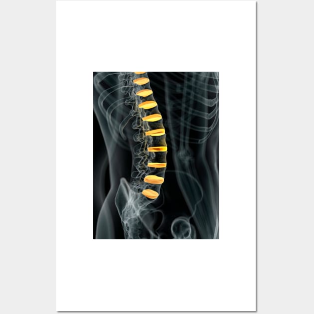 Human spinal intervertebral discs (F011/7098) Wall Art by SciencePhoto